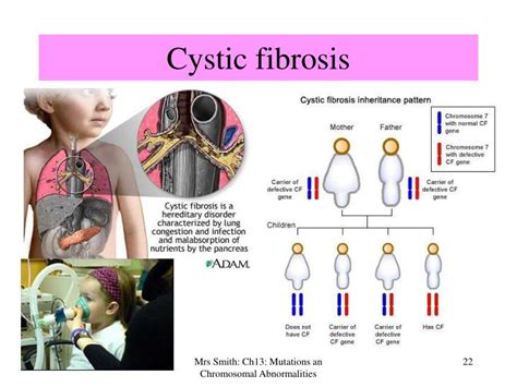 Ppt Chapter 13 Mutations And Chromosomal Abnormalities Powerpoint Presentation Id 4074206