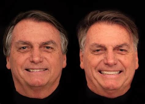 Jornal Correio Bolsonaro Faz Harmoniza O Facial Por R Mil Veja