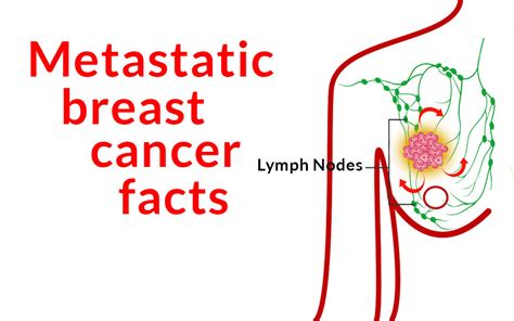 How To Control Metastatic Breast Cancer Dr Zembroski