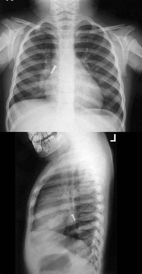 Carina Lung Xray