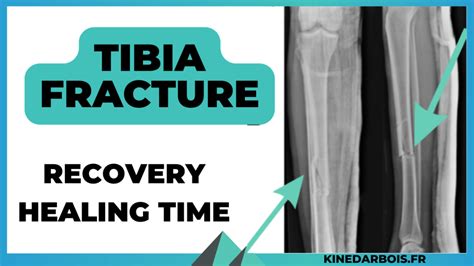 Understanding Tibia Fracture Healing Time in Adults: Guide