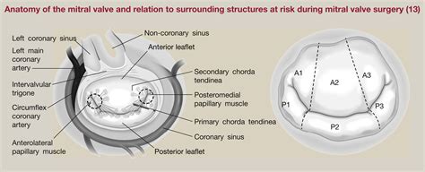 Mitral Valve Replacement Diagram Mitral Valve Replacement