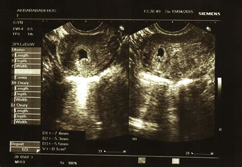 Transvaginal image of a chorionic bump; age of gestation: 8 weeks, 5 ...