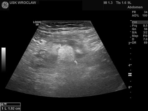 Ultrasound Abdominal Examination Of A Patient With Left Lower Quadrant