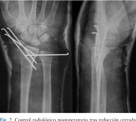 Figure From Fractura Luxaci N Radiocarpiana Transestiloidea Con