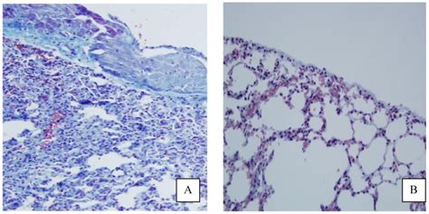 Appearance Of Pleural Fibrosis On Lung Side With And Without Treatment