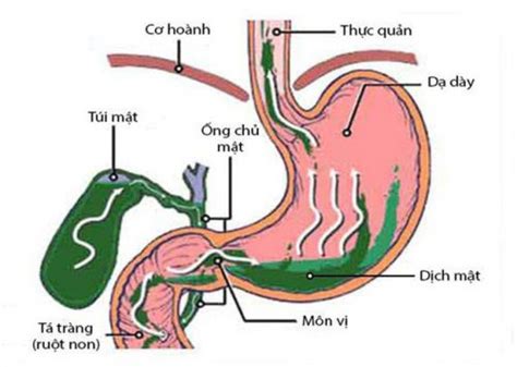 Mối Quan Hệ Giữa Trào Ngược Dịch Mật Và Trào Ngược Dạ Dày Thực Quản