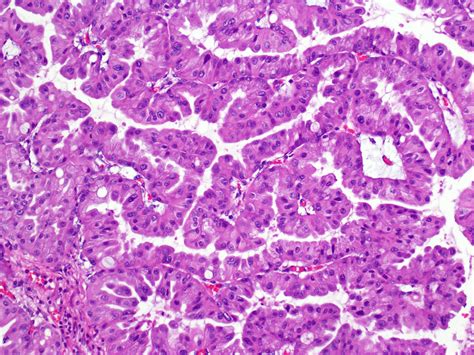 Pathology Outlines Intraductal Oncocytic Papillary Neoplasm IOPN