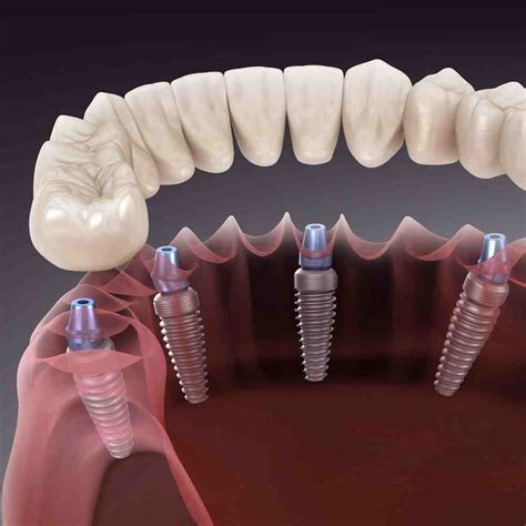 Implant Cost Per Tooth In India