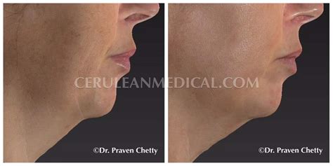 Ipl Before And After Photo 1 Cerulean Medical Institute Kelowna Bc