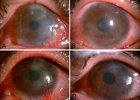 Characteristics Of Immune Rejection After Allogeneic Cultivated Limbal