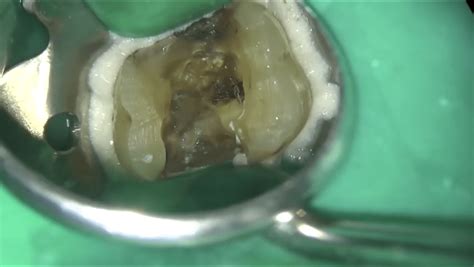 Decoding The Pulp Floor Key Topics In Restorative Dentistry