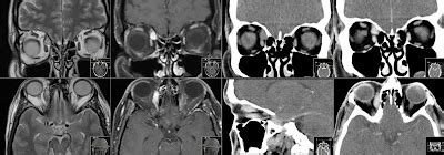 Orbital Cavernous Hemangioma MRI - Radiology Imaging