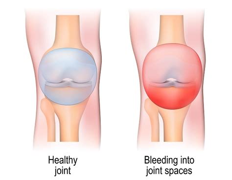 Hemarthrosis - Gejala, penyebab dan mengobati - Alodokter