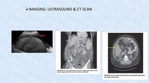 3 ASCITES Part 1 Pdf