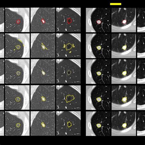 Visualization Of Lung Nodule Segmentation Results From Top To Bottom