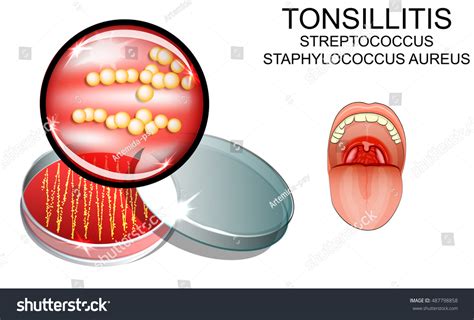 Staph Throat Infection: Over 9 Royalty-Free Licensable Stock ...