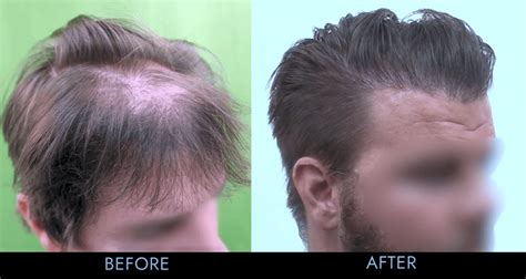 Best Hair Transplant Results