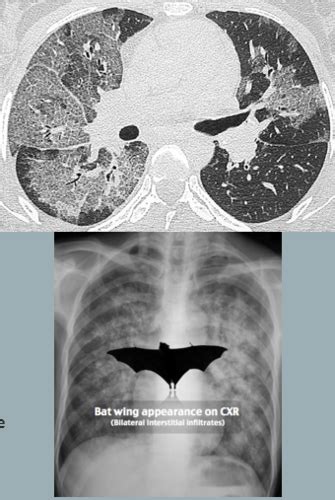 Pulmonology Flashcards Quizlet