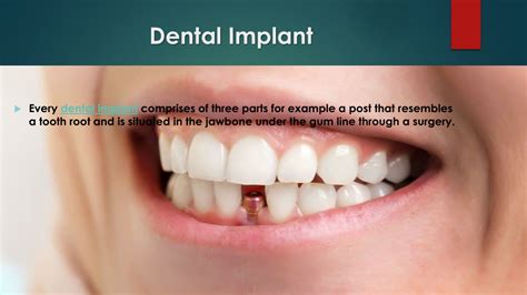 PPT Dental Implant Advantages And Disadvantages PowerPoint