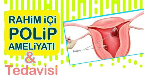 Polip Nedir Rahim İçi Polip Ameliyatı ve Tedavisi Hakkında Merak