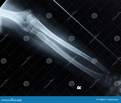 Forearm X-ray Royalty-Free Stock Photo | CartoonDealer.com #15325695