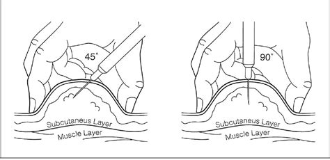 Subcutaneous Injection Sites, How To Give Subcutaneous, 60% OFF