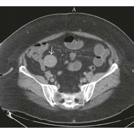 Axial Abdominal Computed Tomography Revealing Ileoileal Intussusception