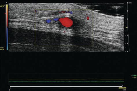 A Brief Overview Of Ophthalmic Ultrasound Imaging Intechopen