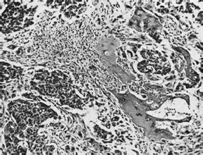 Sex Cord Stromal Steroid Cell And Germ Cell Tumors Of The Ovary GLOWM