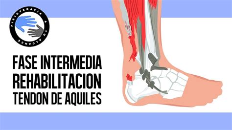 Rotura Del Tendon De Aquiles Ejercicios Y Rehabilitacion Postcirugia