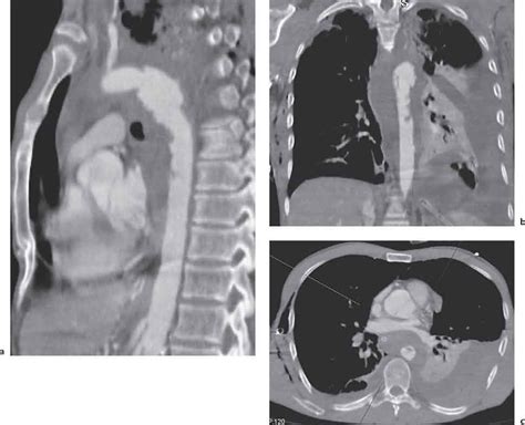 Diseases Of The Mediastinum Radiology Key