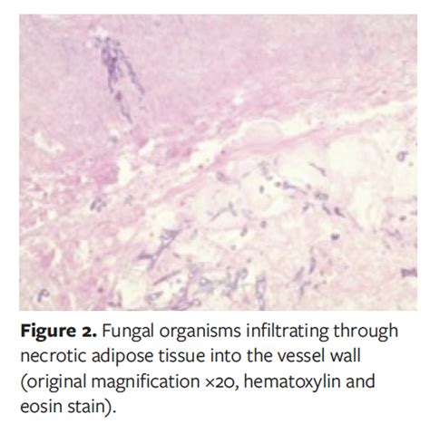 Primary Cutaneous Mucormycosis Of The Lower Extremity In A Male Patient