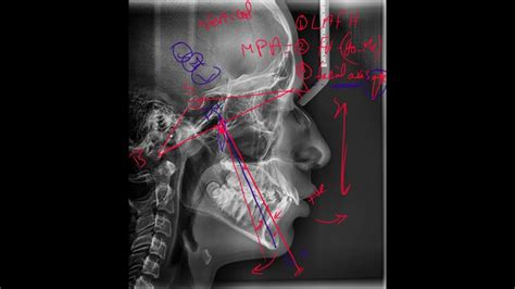 13 Mcnamara Analysis Cephalometric Analysis Youtube