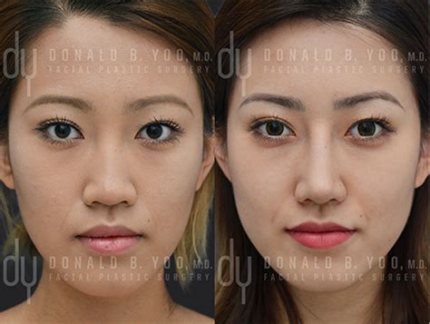 Asian Rhinoplasty Before And After