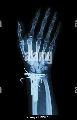 Film X Ray Wrist Ap Show Fracture Distal Radius Forearm S Bone It