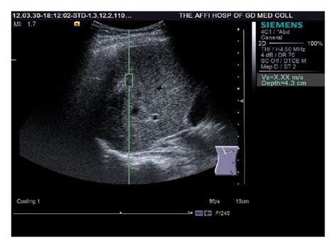 Virtual Touch Tissue Quantification Vtq Before A And After B Rfa Download Scientific