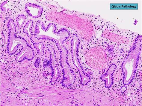 Qiao S Pathology Angiodysplasia Of The Gallbladder A Photo On Flickriver