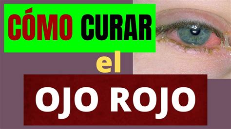 CÓmo Curar El Ojo Rojo Conjuntivitis Bacteriana Youtube