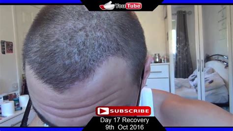 Fue Hair Transplant Day 17 Post Op Recovery Youtube