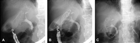 Comparison Of The Long Term Outcomes Of Eus Guided Gallbladder Drainage