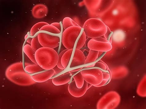 Understanding Blood Clots And How To Treat Them