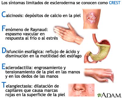 S Ndrome Crest Medlineplus Enciclopedia M Dica Illustraci N