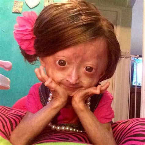 EL MUNDO DE MONIQ Adalia Rose la niña que envejece rápidamentese es