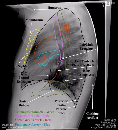 Chest Undergraduate Diagnostic Imaging Fundamentals