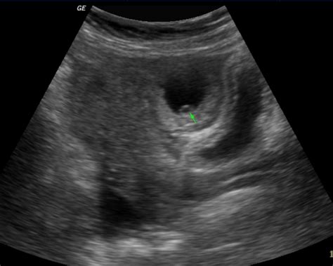 Ultrasound Evaluation Of Ectopic Pregnancy Eurorad