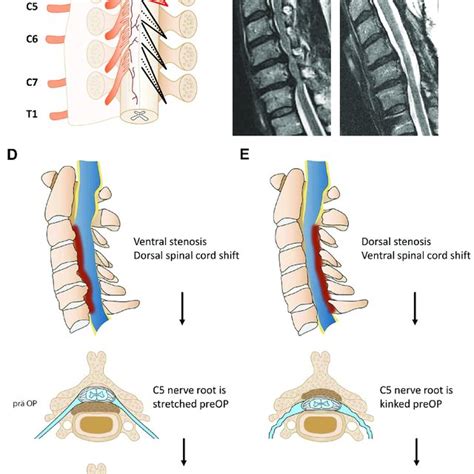 Spinal Nerve Roots Chart