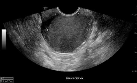 Transvaginal ultrasound of vaginal mass. The transvaginal ultrasound... | Download Scientific ...