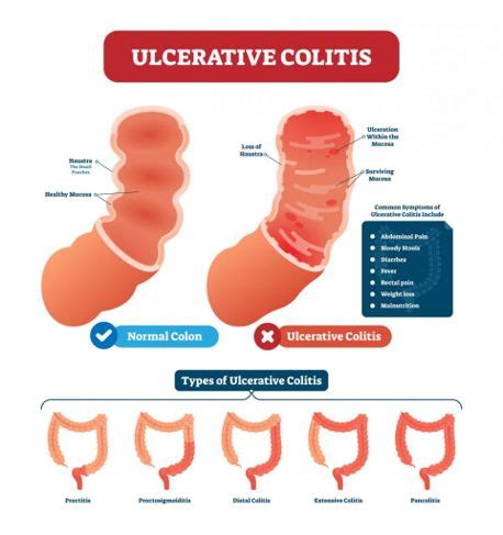 10 Causes of Hematochezia - Health & Detox & Vitamins