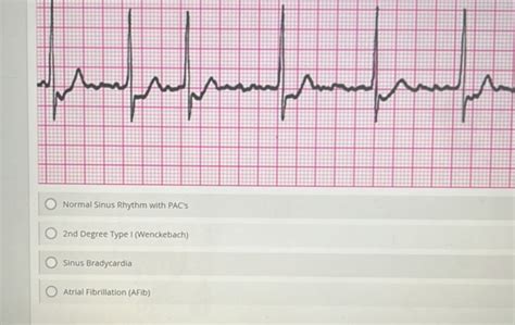 Normal Sinus Rhythm with PACs 2nd Degree Type | StudyX